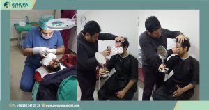 زراعة الشعر للرجال في تركيا