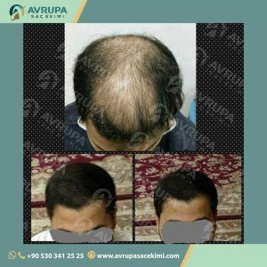 نتائج زراعة الشعر في المركز الاوروبي
