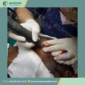 زراعة الشعر للرجال