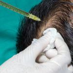 نتائج زراعة الشعر المركز الأوروبي لزراعة الشعر , محمد قوتشلو