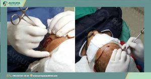 زراعة الشعر للرجال