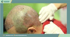 زراعة الشعر للرجال Hair Transplant in turkey