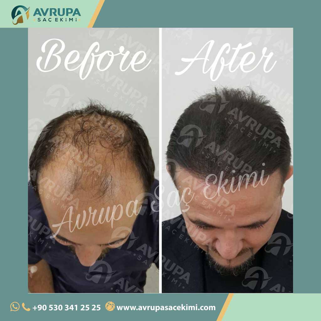 نتائج زراعة الشعر المركز الأوروبي لزراعة الشعر , محمد قوتشلو