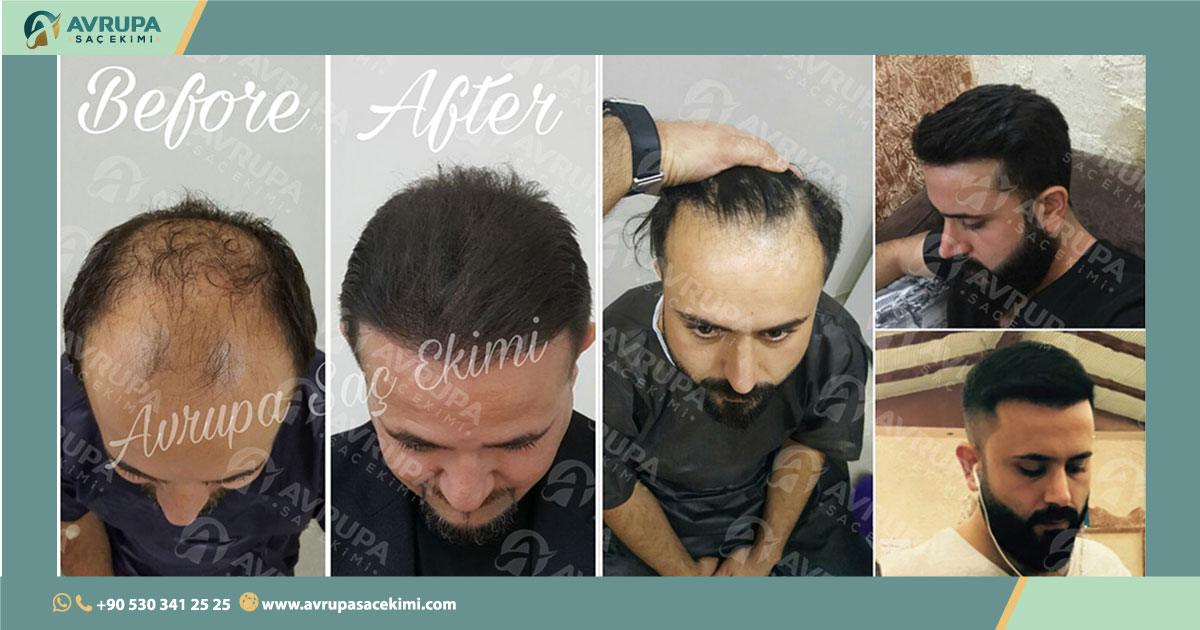 Hair Transplant In Turkey Reviews | AVRUPA SACEKiMi