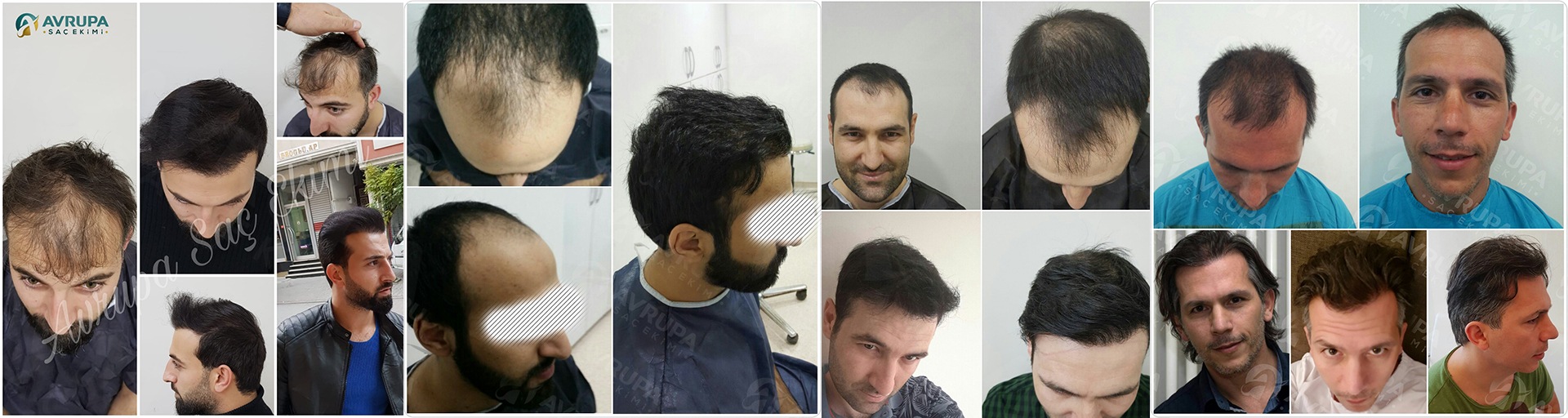 Hair transplant in Turkey before and after- 6 real cases with photos