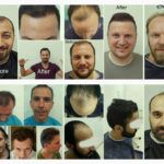 Avrupa Saç Ekimi Hair Transplant