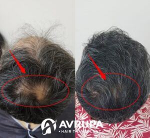 hair transplant for crown area
