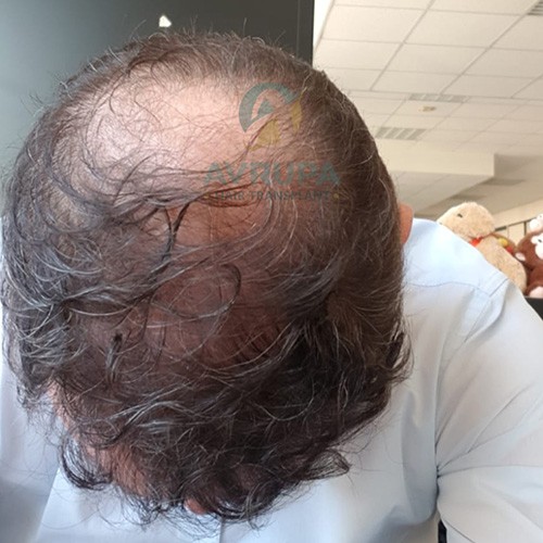 Hair Transplant Recovery Time Expectations, Timeline & Precautions