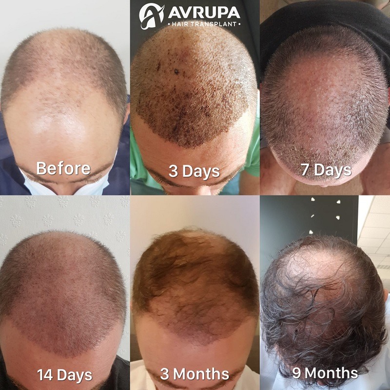 Hair Transplant Recovery Time Expectations, Timeline & Precautions