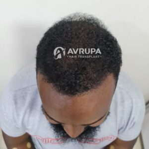 Afro Hair Transplant Turkey 