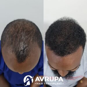Afro Hair Transplant Turkey Results (Top View) : Avrupa Hair Transplant Clinic