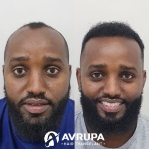 Afro Hair Transplant Turkey Results (Front View) : Avrupa Hair Transplant Clinic