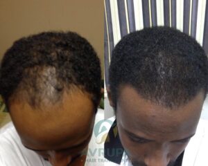 Afro Hair Transplant Before After (Top View) : Avrupa Hair Transplant Clinic
