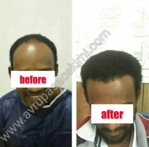 Afro Hair Transplant Before After (Front View) : Avrupa Hair Transplant Clinic