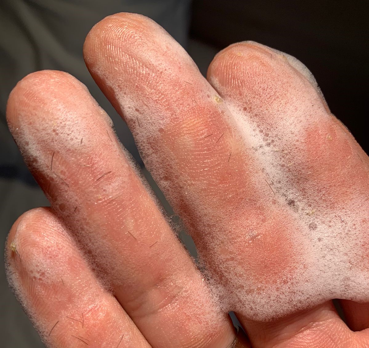 Best Way to Remove Scabs After Hair Transplant Avrupa Hair Transplant