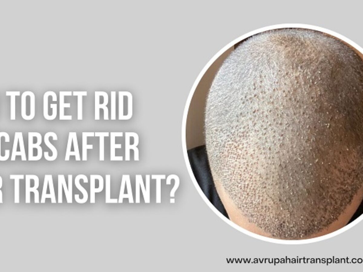 Best Way to Remove Scabs After Hair Transplant | Avrupa Hair Transplant
