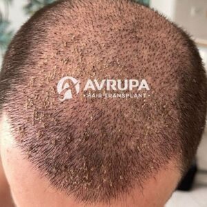 Best Way to Remove Scabs After Hair Transplant | Avrupa Hair Transplant