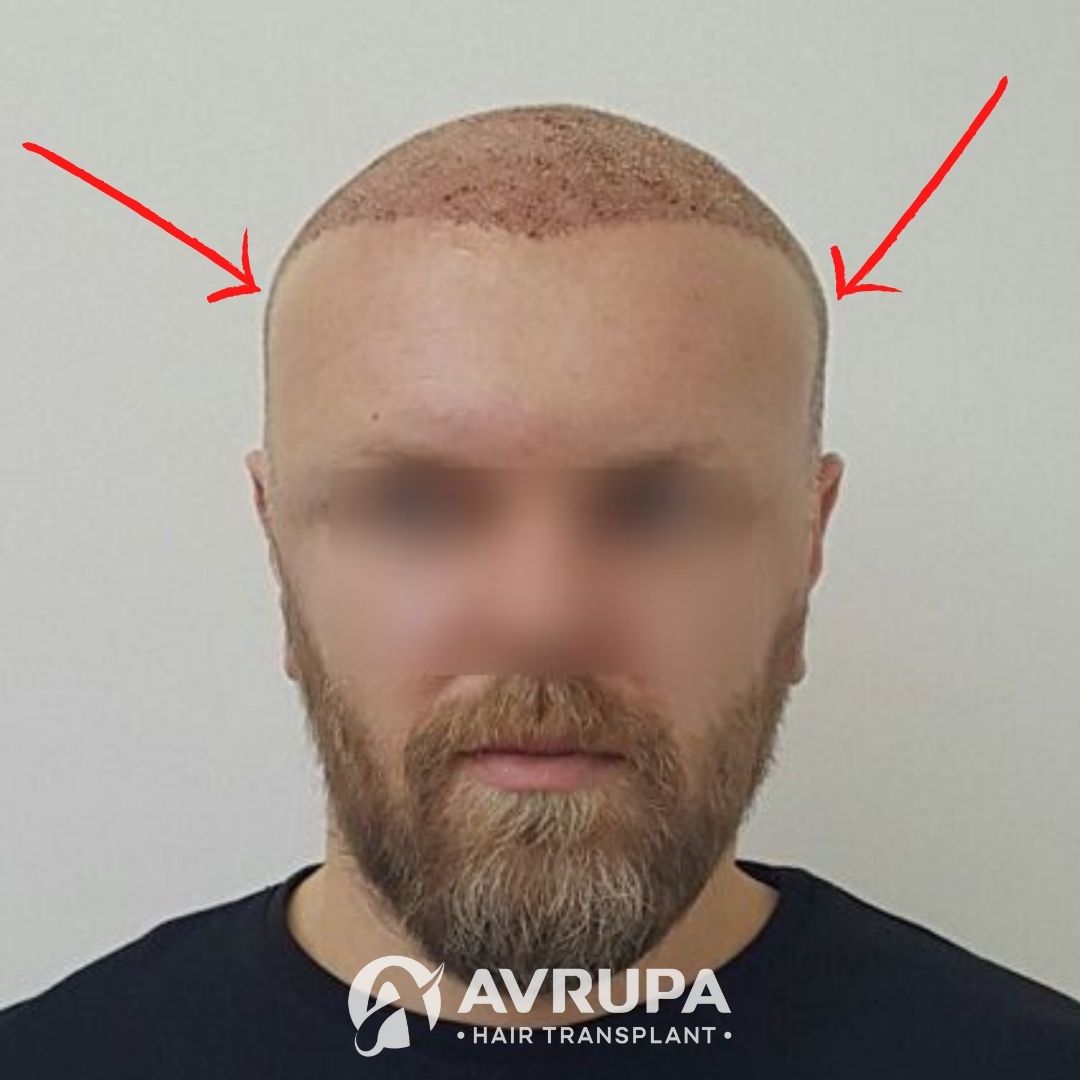 Side Effects of Hair Transplant What to Expect & How to Prevent Them