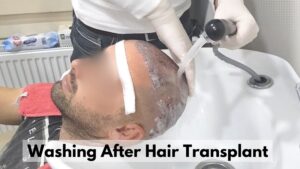 washing hair after hair transplant