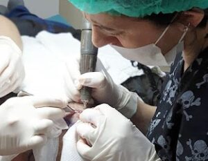 FUE Hair Transplant