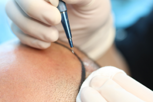 Sapphire Hair Transplant