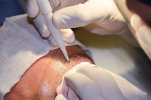 DHI Hair Transplant
