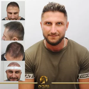 Before and After FUE Hair Transplant in Turkey