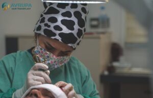 Talentosos cirujanos de trasplante de cabello turco