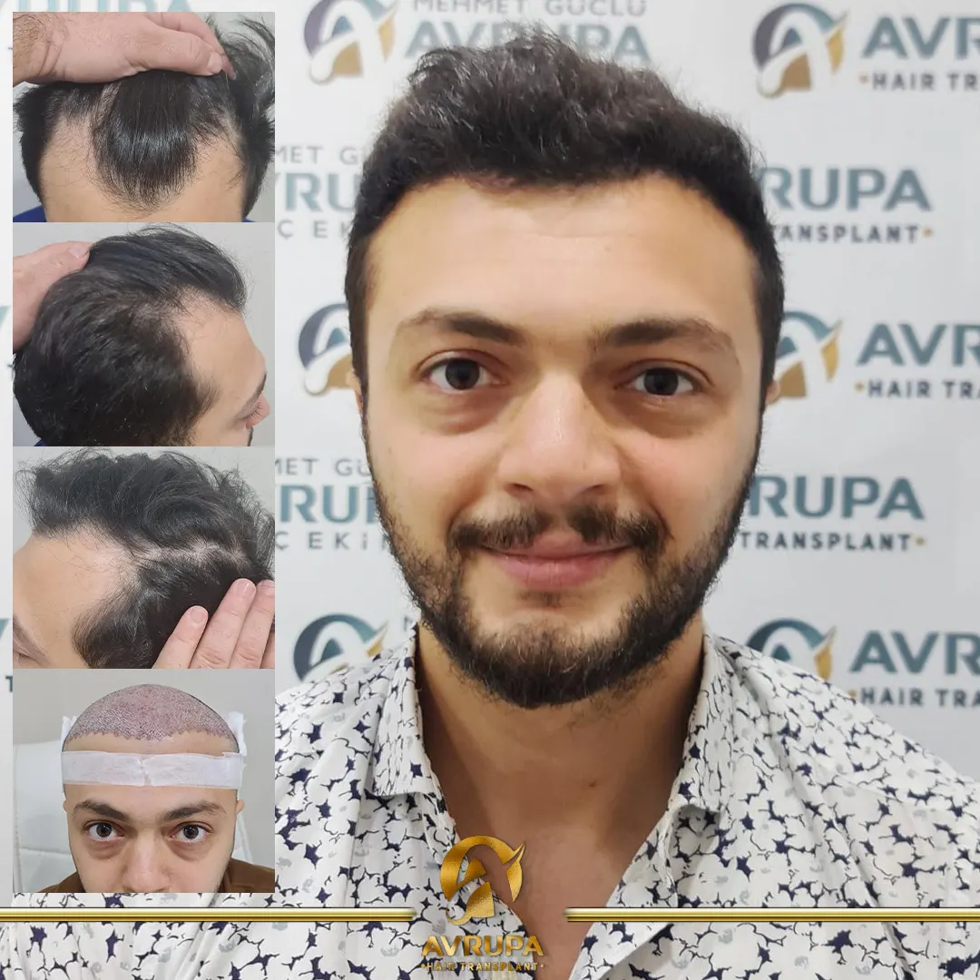 DHI hair transplant results Turkey