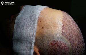 precio del trasplante capilar - número de injertos