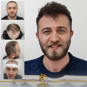 Sapphire FUE Turkey Results