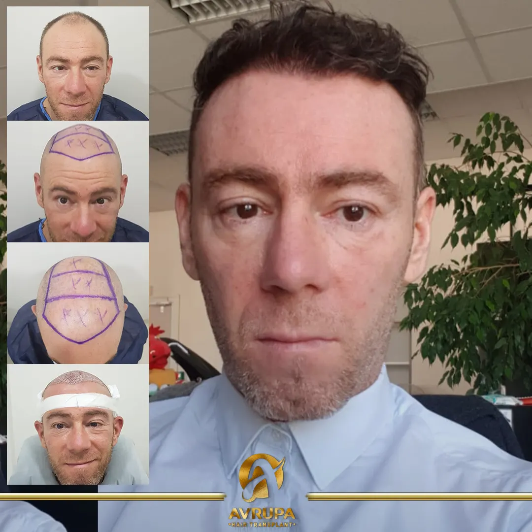 avrupa hair transplant
