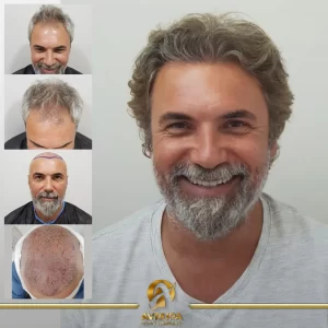 Before & After Sapphire FUE Turkey