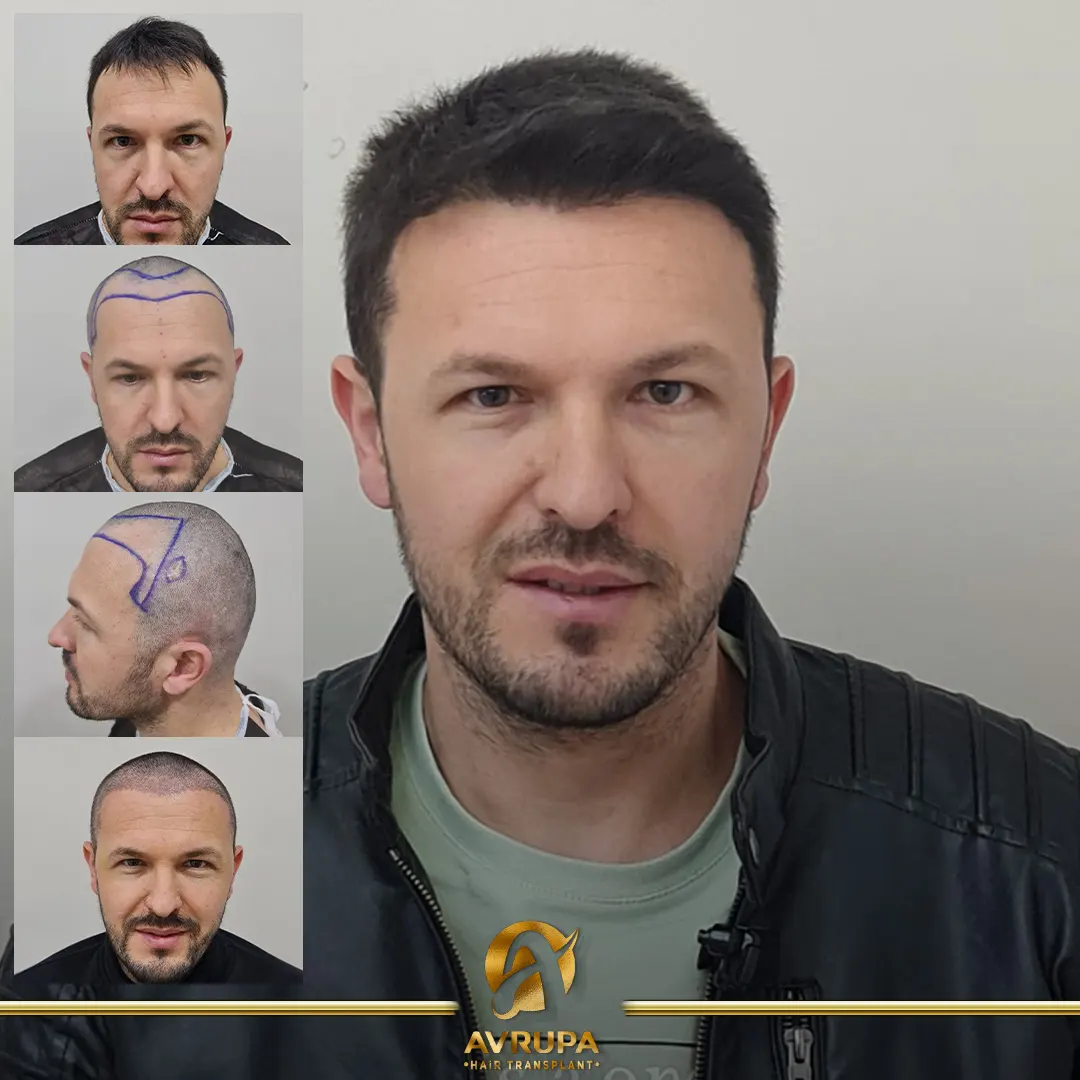 avrupa hair transplant
