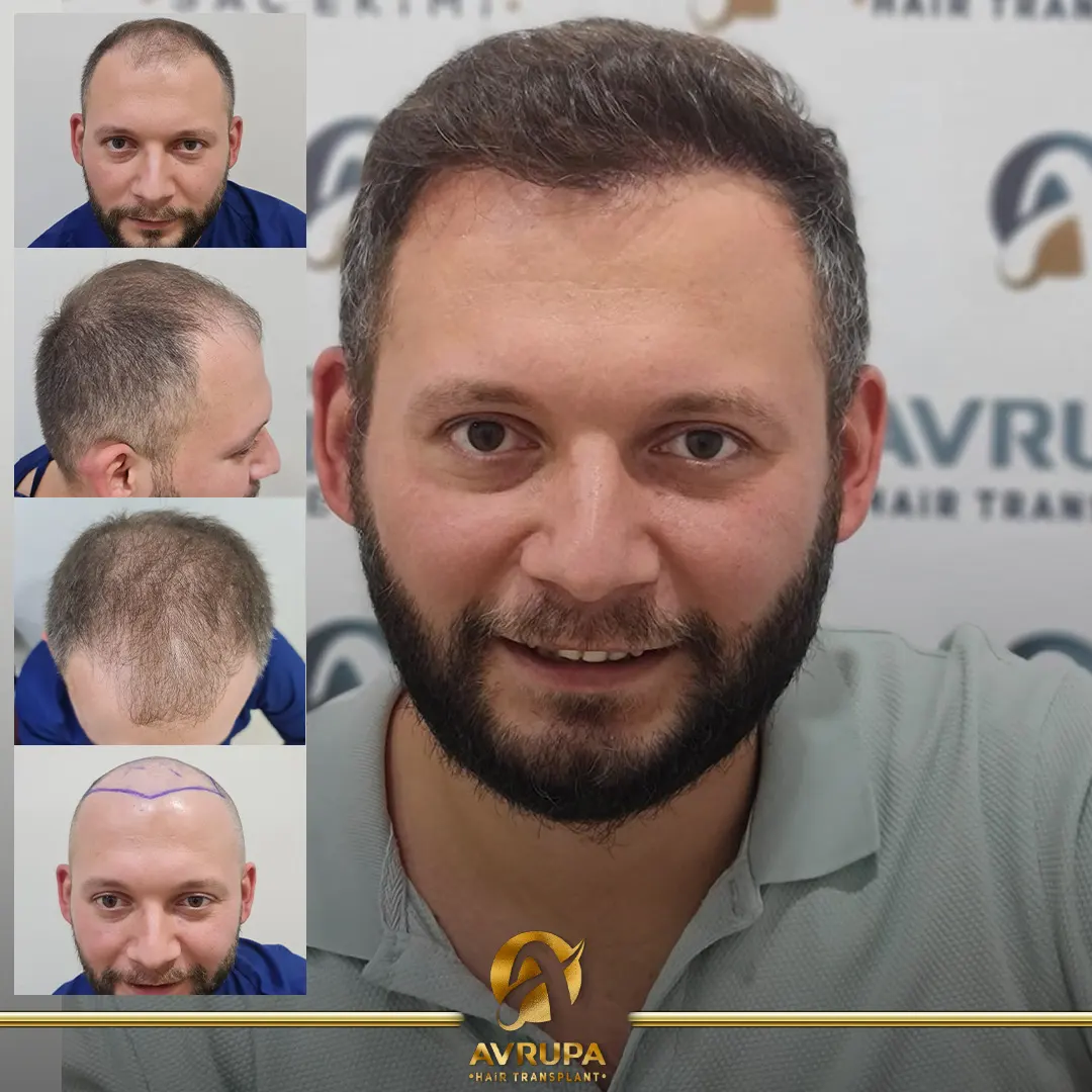 avrupa hair transplant