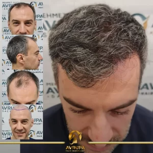 FUE hair transplant results Turkey
