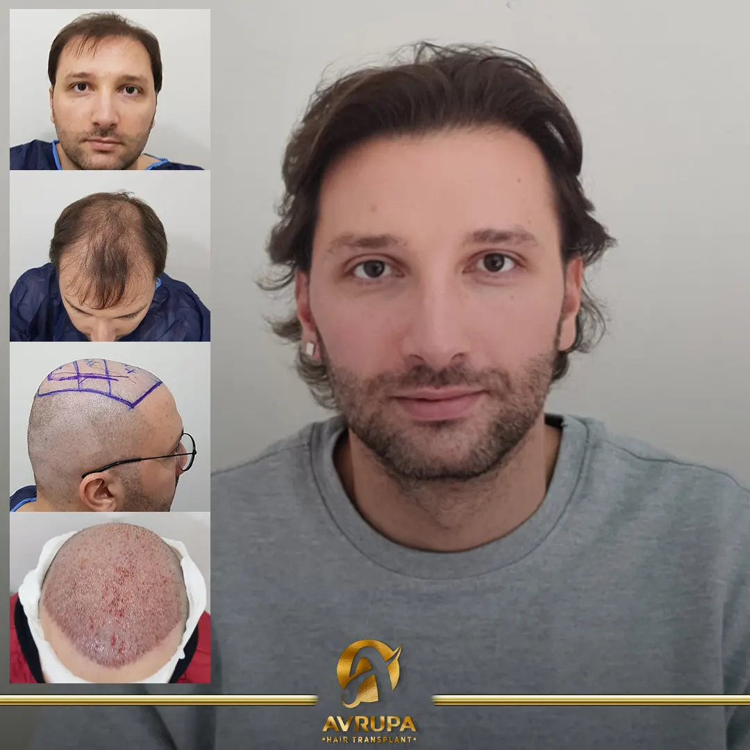avrupa hair transplant