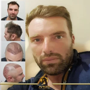 DHI hair transplant in Turkey - Before/After