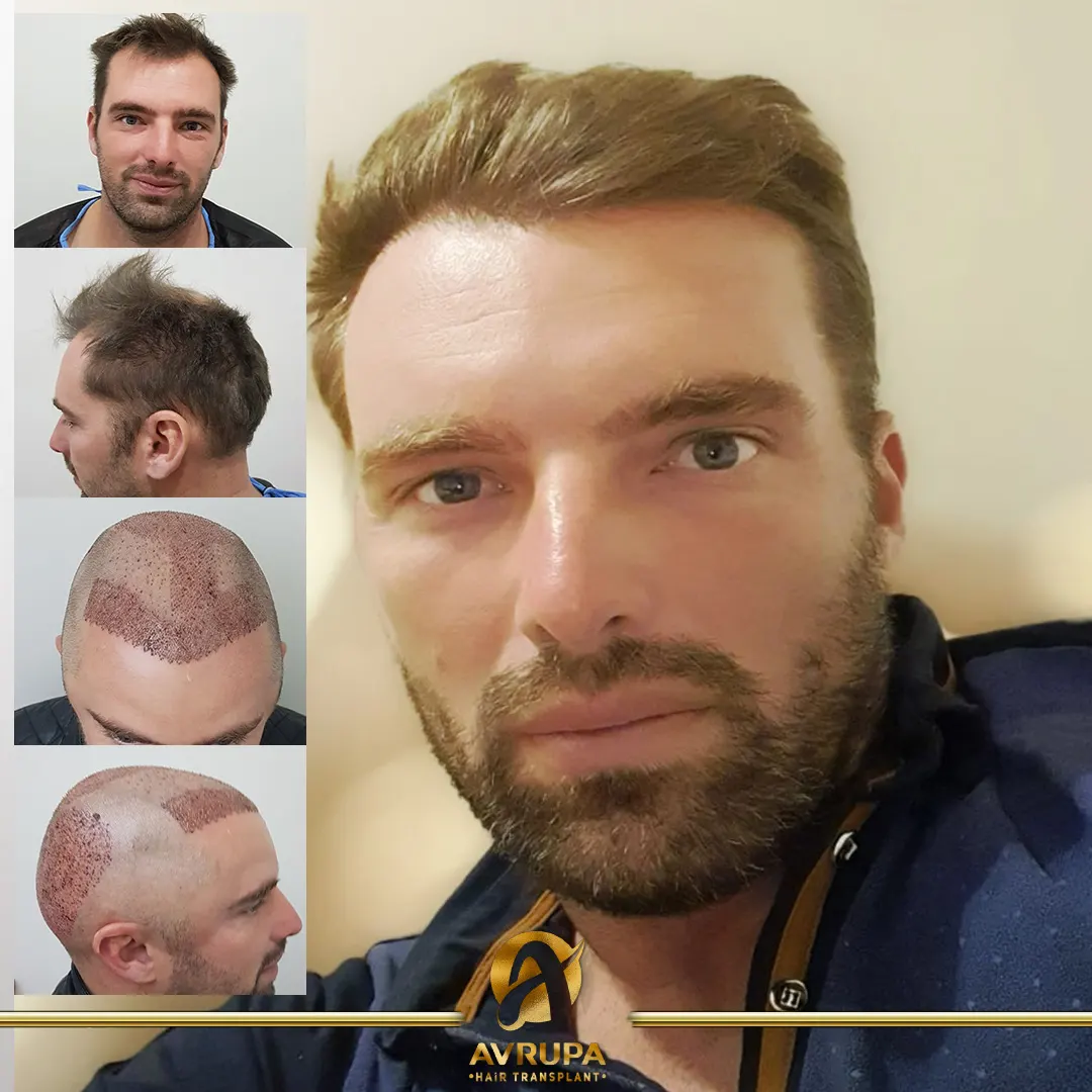 avrupa hair transplant