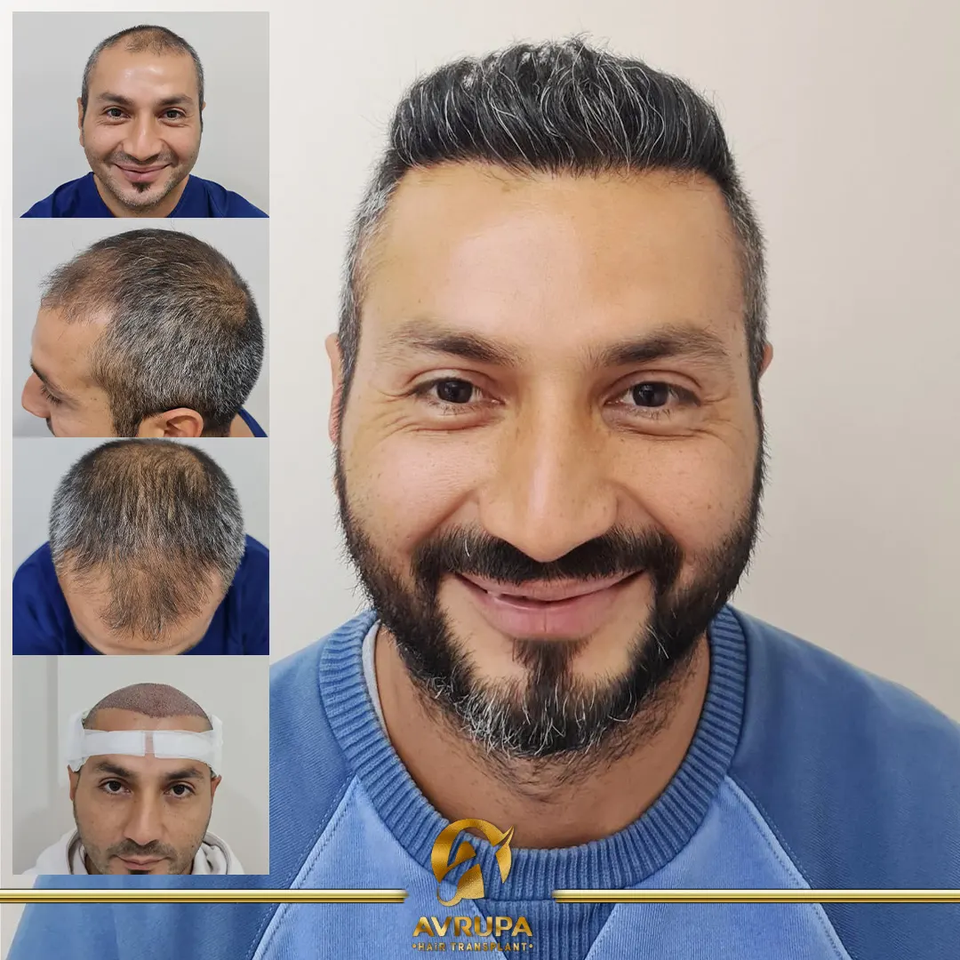 avrupa hair transplant