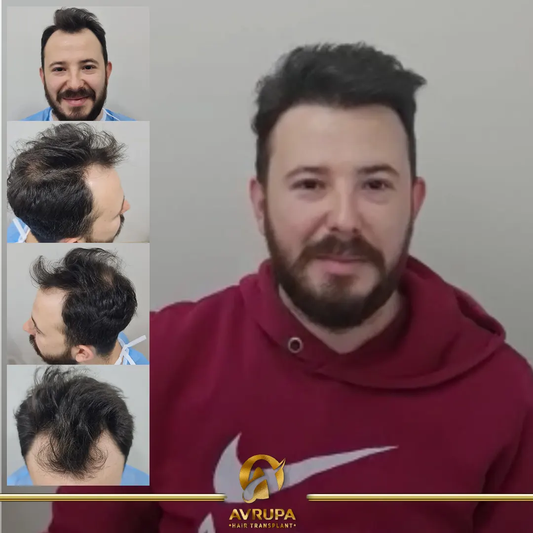 avrupa hair transplant