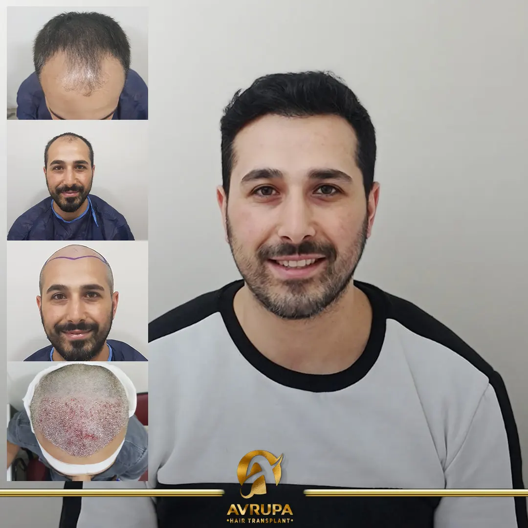 avrupa hair transplant