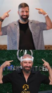 FUE Turkey Before After - Case 1