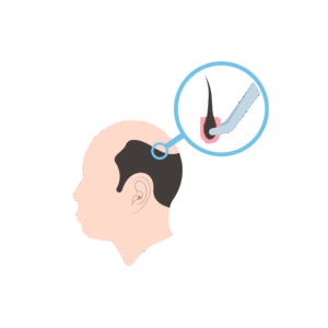 cutting edge hair transplant techniques