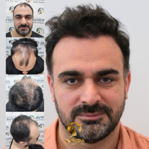 FUE technique results - Case 6