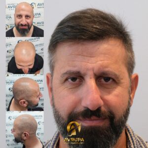 FUE Turkey Before After - Case 2