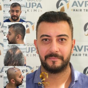 Before After FUE - Case 5