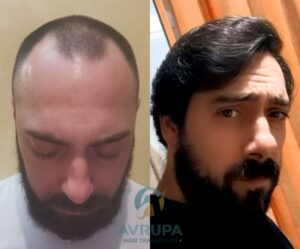 Norwood Stage 3 - Actual Avrupa Hair Transplant Patient